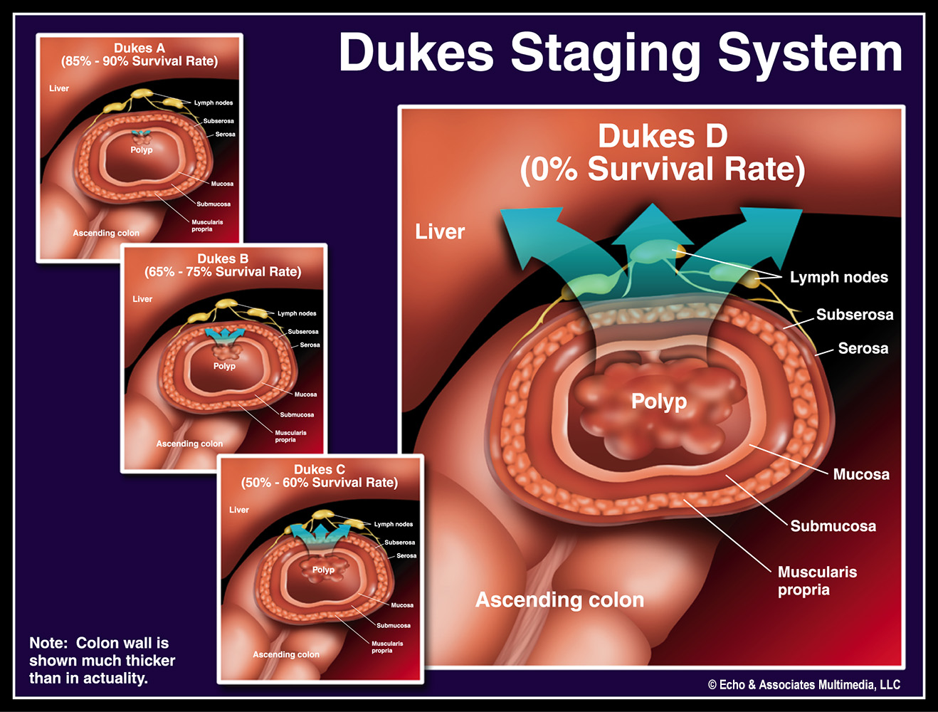 Dukes Staging System